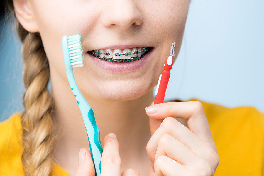 Braces 101: Everything You Need to Know Before Getting Them