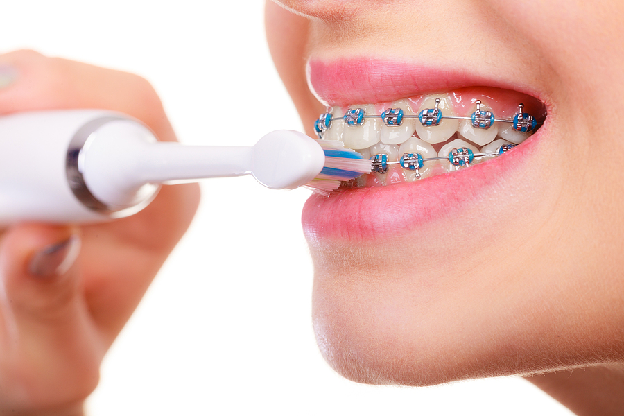 What to Expect When Getting Braces: A Step-by-Step Guide